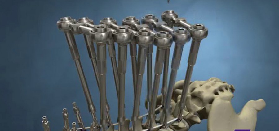 Stryker supera el millón de tornillos Mesa implantados'